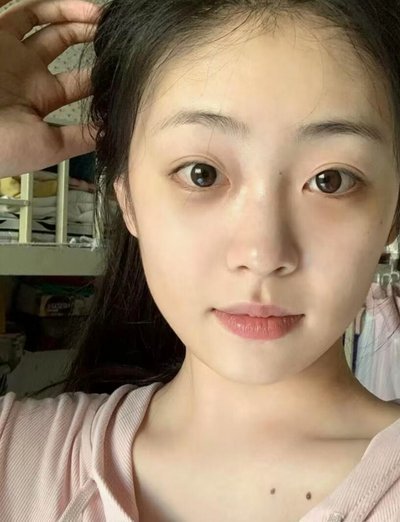 黑眼圈深层解析：从遗传到体质的全面成因图鉴